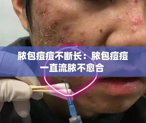 膿包痘痘不斷長(zhǎng)：膿包痘痘一直流膿不愈合 